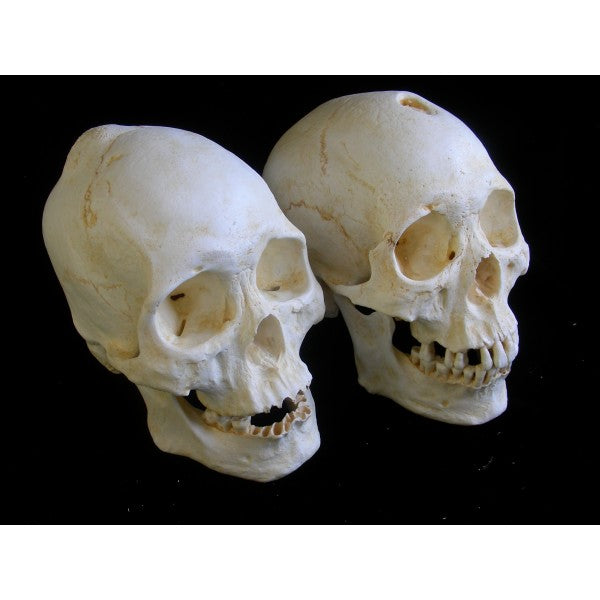 Mongoloid Pathological Male Skull (Benign bone tumor) - dinosaursrocksuperstore