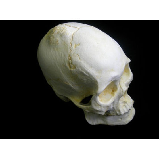 Mongoloid Pathological Male Skull (Benign bone tumor) - dinosaursrocksuperstore