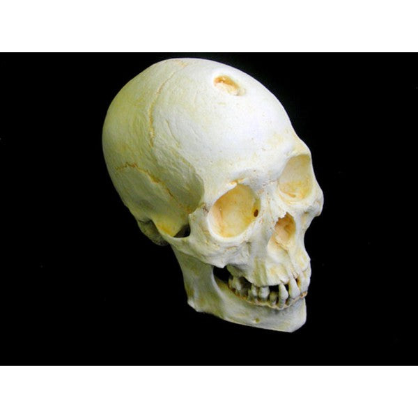 Mongoloid Male Asian Skull (Healing trepanation) - dinosaursrocksuperstore